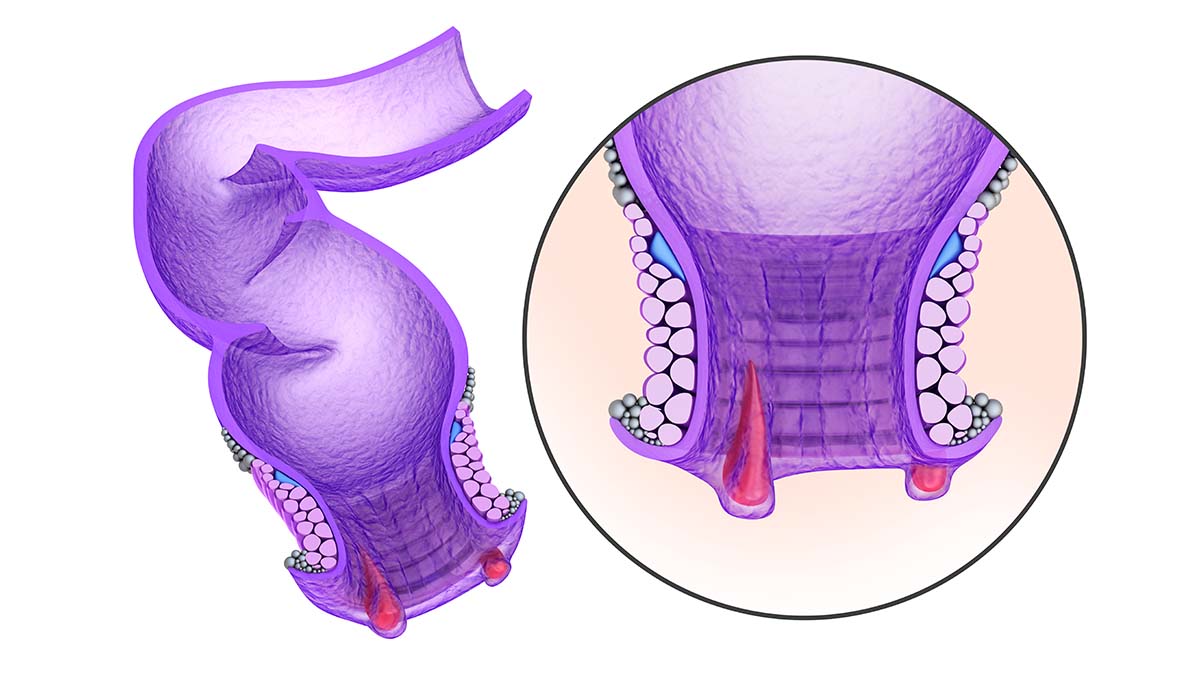 Hemoroid (Basur) Nedir? Basur (Hemoroid) Belirtileri ve Tedavisi
