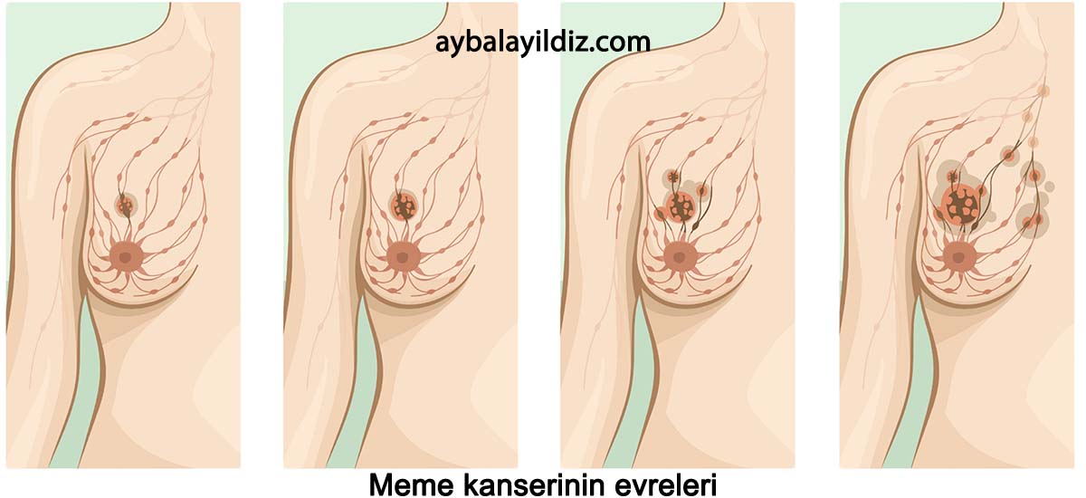 Meme Kanseri Evreleri Nelerdir?