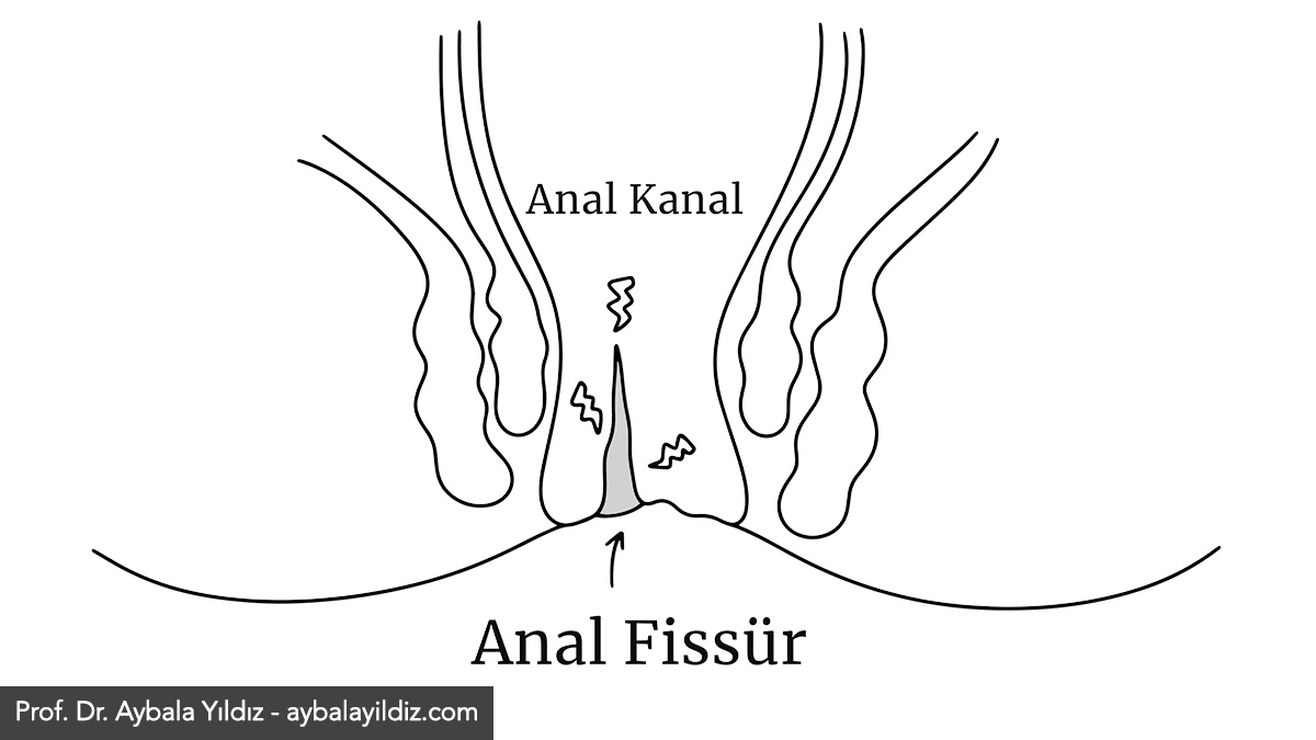 Anal Fissür (Makat Çatlağı) Nedir? Anal Fissür Nedenleri, Belirtileri ve Tedavisi