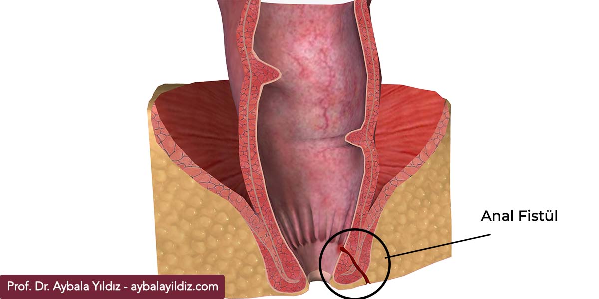 Anal Fistül Nedir? Anal Fistül Belirtileri ve Tedavi Yöntemleri