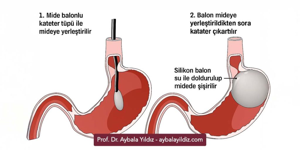 Mide Balonu Nedir, Nasıl Uygulanır? Mide Balonu Kimlere Uygundur?