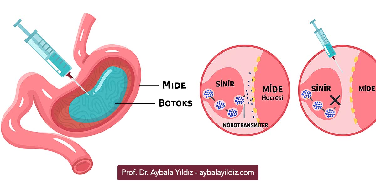 Mide Botoksu Nedir, Nasıl Uygulanır? Mide Botoksu ile Zayıflama